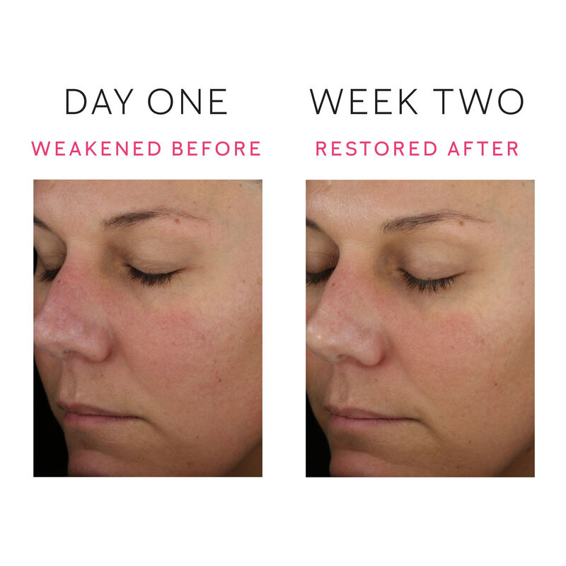 Before-and-after images showing visibly reduced skin redness from day one to week two.